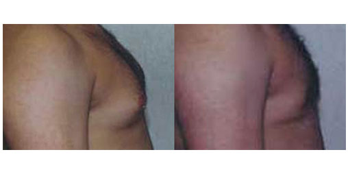 male patient before and after breast reduction surgery