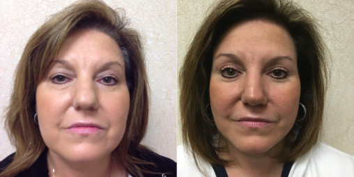 before and after results of forehead lift surgery