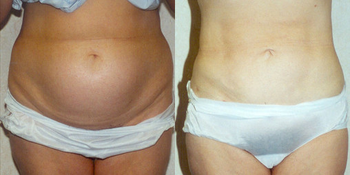 before and after results of liposuction surgery