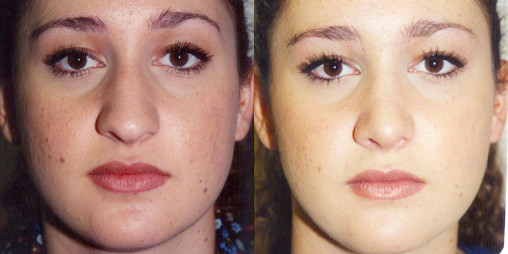female patient before and after rhinoplasty surgery