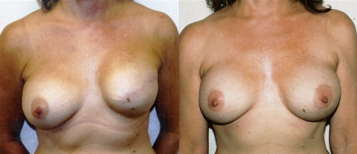 patient before and after breast reconstruction surgery
