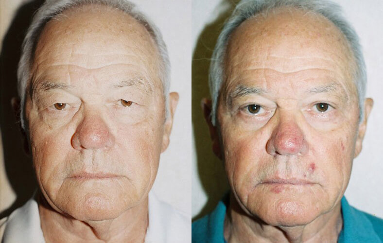 male patient before and after blepharoplasty surgery