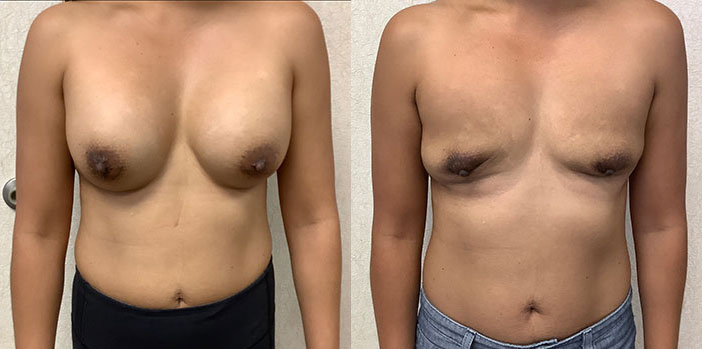 before and after results of en bloc capsulectomy