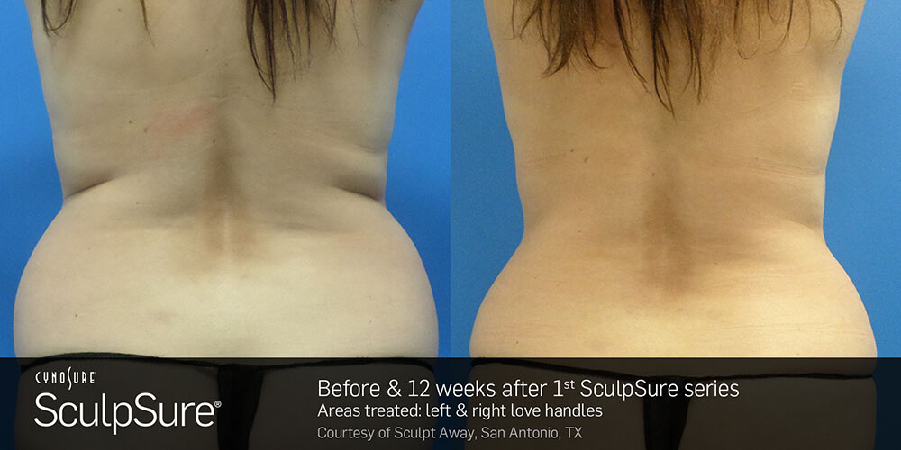 Sculpsure before and after results backview