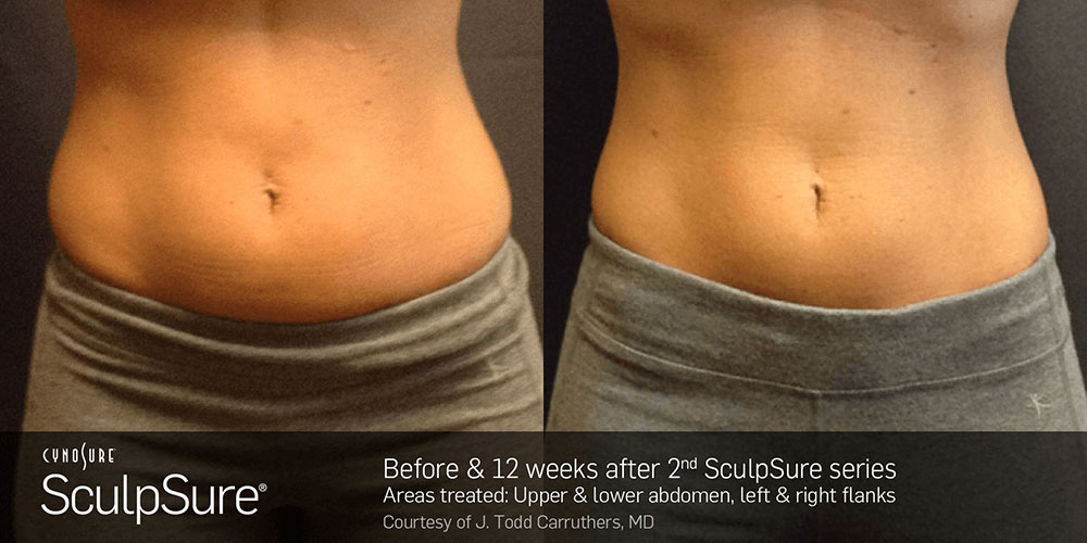 Sculpsure before and after results frontview