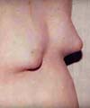 Orange County Male Breast Reduction