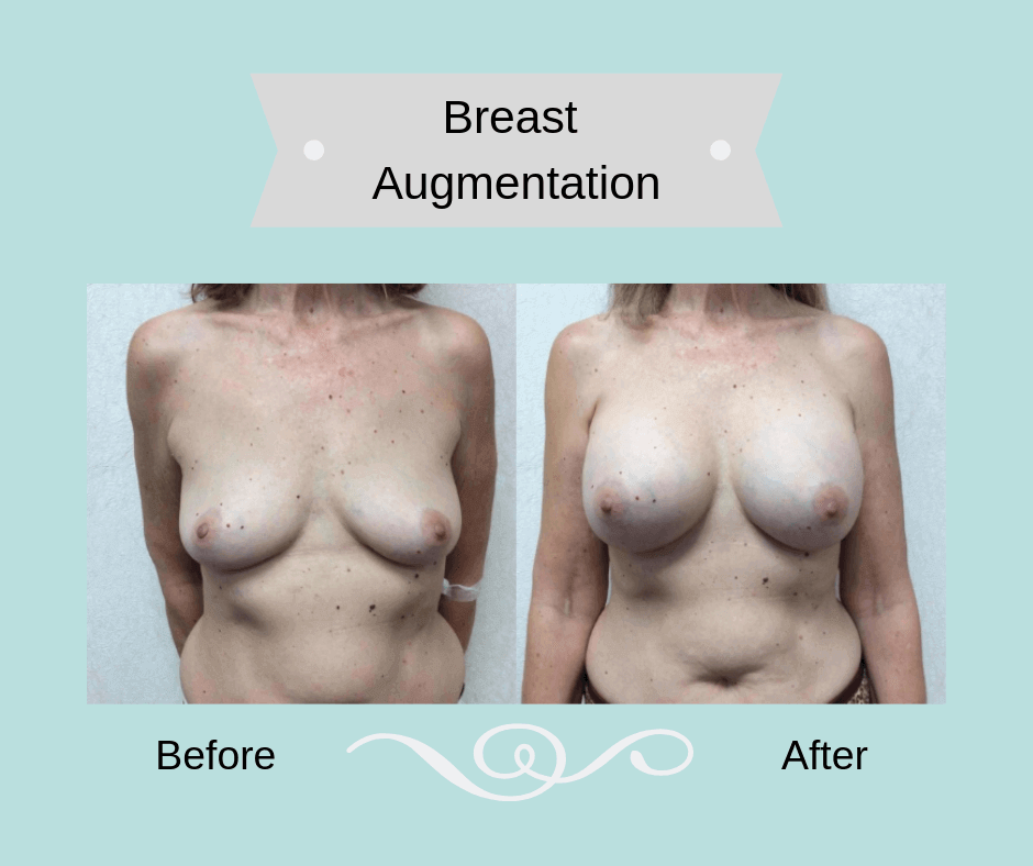 Breast-Augmentation-20-08-Blog-BA-Img (1)