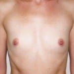 Breast Augmentation 01 Before Thumbnail Photo