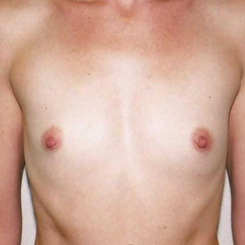 Breast Augmentation 01 Before Photo