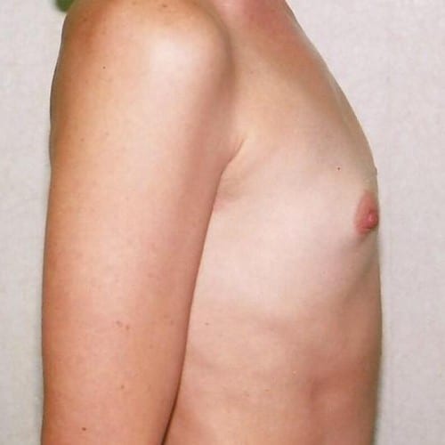 Breast Augmentation 01 Before Photo