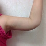 Brachioplasty 01 After Thumbnail Photo