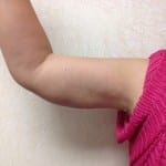 Brachioplasty 01 After Thumbnail Photo