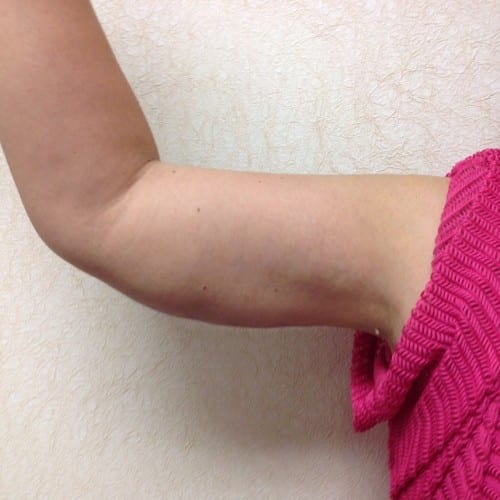 Brachioplasty 01 After Photo