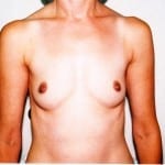 Breast Augmentation 03 Before Thumbnail Photo