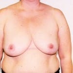 Breast Reduction 01 After Thumbnail Photo