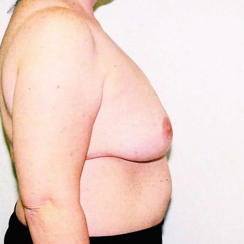 Breast Reduction 01 After Photo