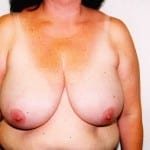 Breast Reduction 01 Before Thumbnail Photo