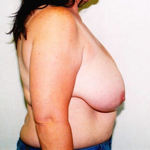 Breast Reduction 01 Before Photo
