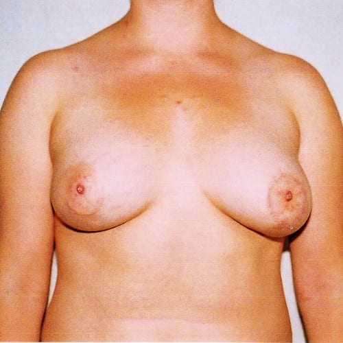 Breast Augmentation 04 After Photo
