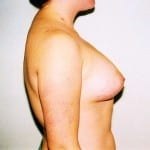 Breast Augmentation 04 After Thumbnail Photo