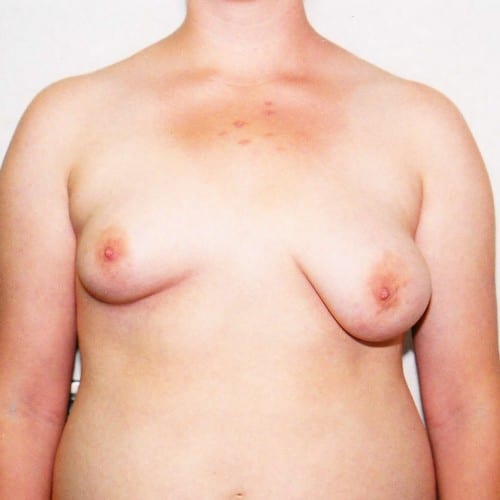 Breast Augmentation 04 Before Photo