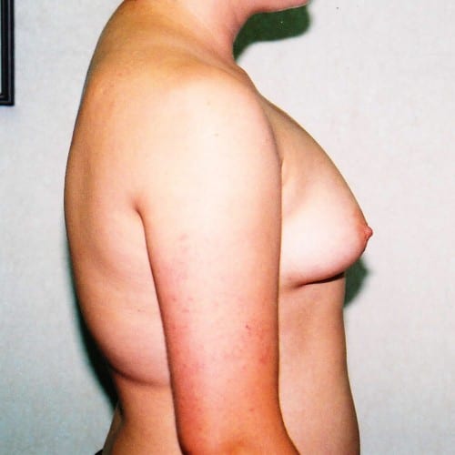Breast Augmentation 04 Before Photo