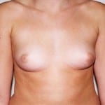 Breast Augmentation 05 Before Thumbnail Photo