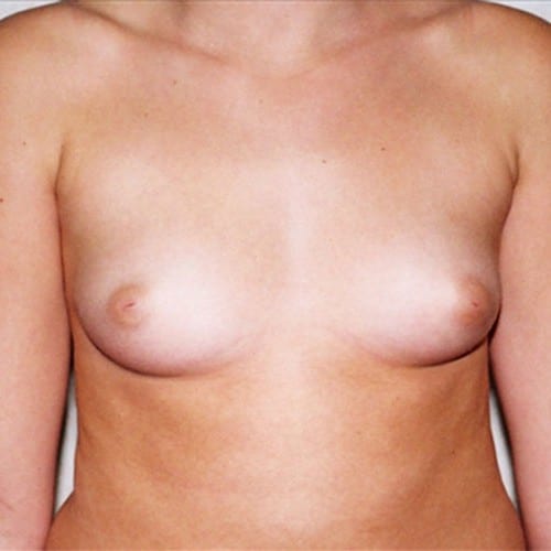 Breast Augmentation 05 Before Photo