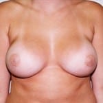 Breast Augmentation 05 After Thumbnail Photo