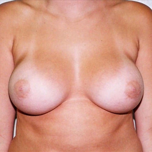Breast Augmentation 05 After Photo