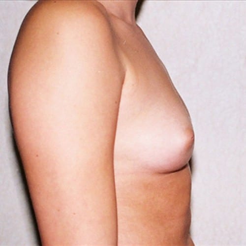 Breast Augmentation 05 Before Photo
