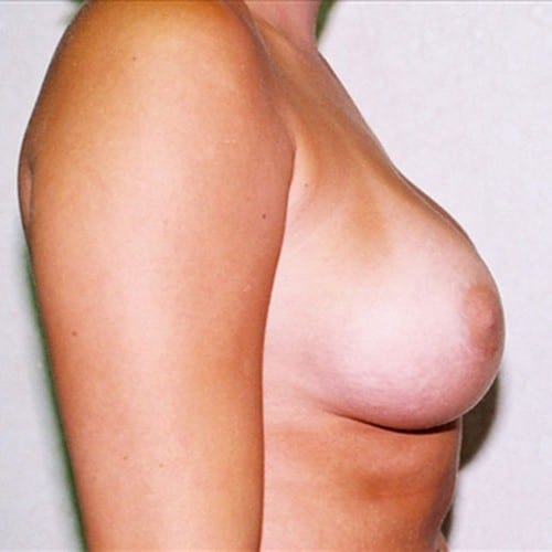 Breast Augmentation 05 After Photo
