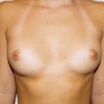 Breast Augmentation 06 Before Thumbnail Photo