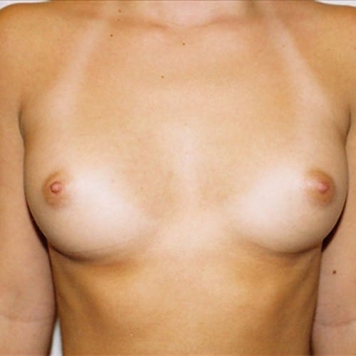 Breast Augmentation 06 Before Photo