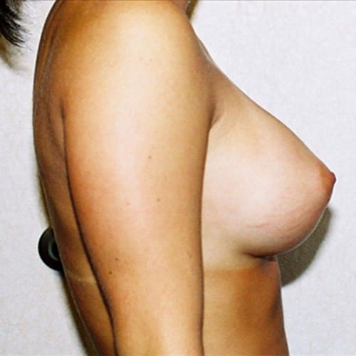 Breast Augmentation 06 After Photo