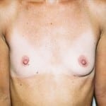 Breast Augmentation 07 Before Thumbnail Photo