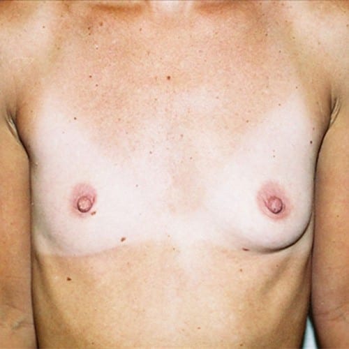 Breast Augmentation 07 Before Photo