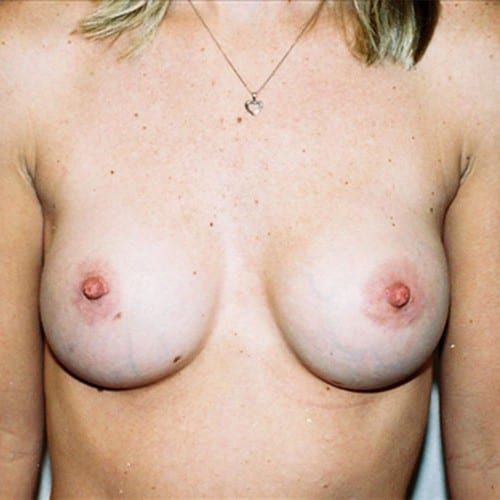 Breast Augmentation 07 After Photo
