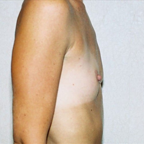 Breast Augmentation 07 Before Photo