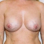 Breast Augmentation 08 After Thumbnail Photo