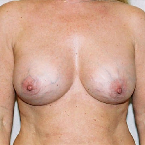 Breast Augmentation 08 After Photo