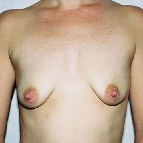 Breast Augmentation 09 Before Photo