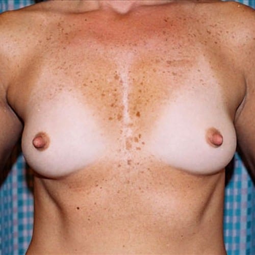 Breast Augmentation 10 Before Photo