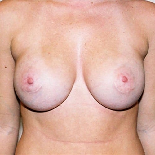 Breast Augmentation 11 After Photo