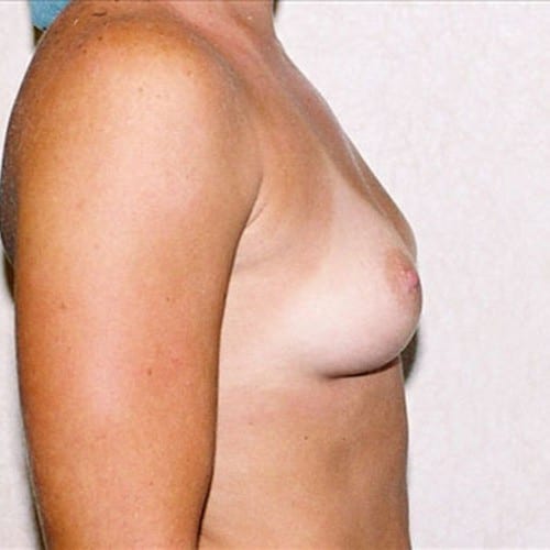 Breast Augmentation 11 Before Photo