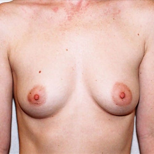 Breast Augmentation 12 Before Photo