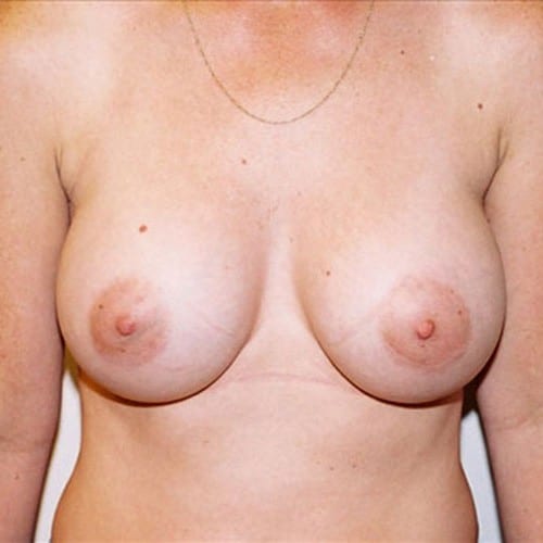 Breast Augmentation 12 After Photo