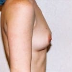 Breast Augmentation 12 Before Thumbnail Photo