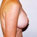Breast Augmentation 12 After Thumbnail Photo
