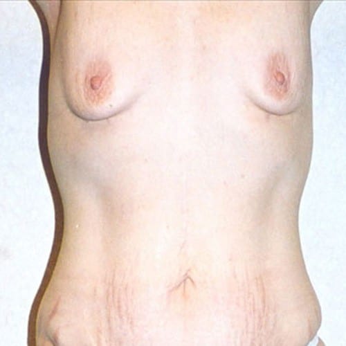 Breast Augmentation 13 Before Photo